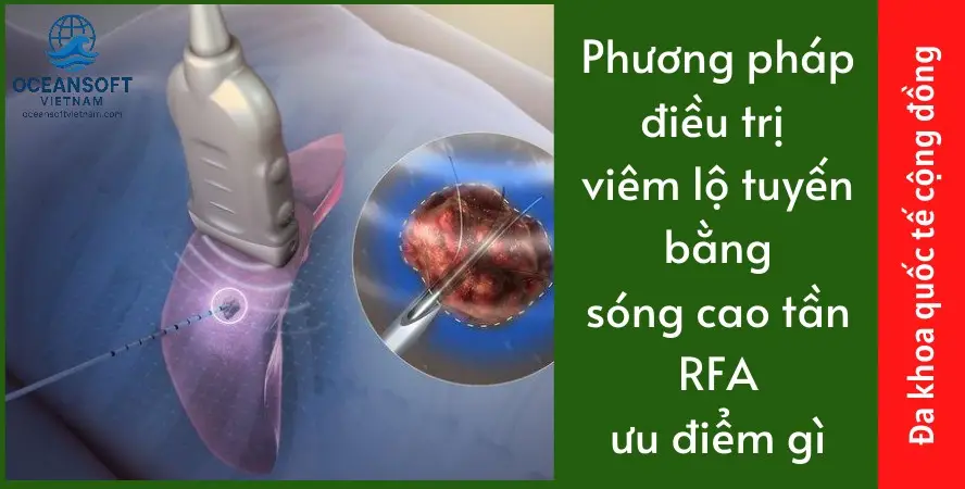 Công Nghệ Điều Trị Viêm Lộ Tuyến Bằng Sóng Cao Tần RFA 2 Ưu Điểm Vượt Trội của Phương Pháp RFA