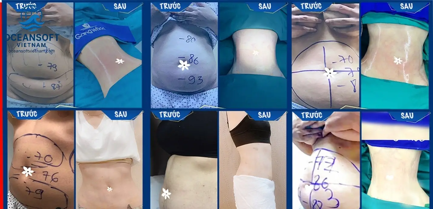 Hút Mỡ Công Nghệ Lipo Ultrasound Có An Toàn Không? 4 Rủi Ro Tiềm Ẩn và Biện Pháp Phòng Ngừa