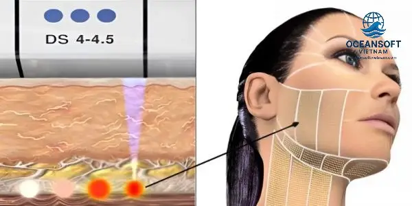 Cơ chế hoạt động và hiệu quả của Ultherapy Cơ chế hoạt động và hiệu quả của Ultherapy
